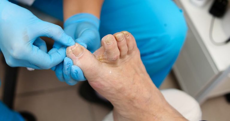 How to Treat Thick Toenails in Elderly